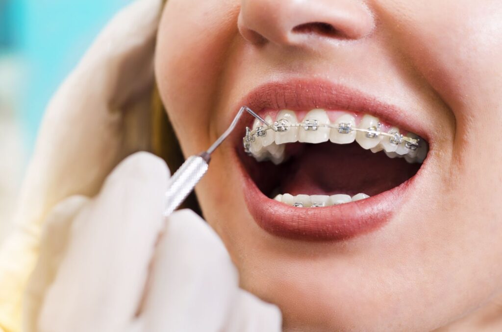 Why Adults in Sunrise Are Choosing Braces